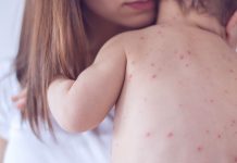 Drastičan porast broja slučajeva malih boginja u Evropi i Centralnoj Aziji – neophodne hitne mere vakcinacije