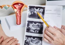 Endometrioza često neprepoznata godinama – potreban dublji i sveobuhvatniji pristup lečenju