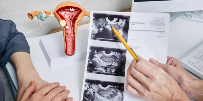 endometrioza